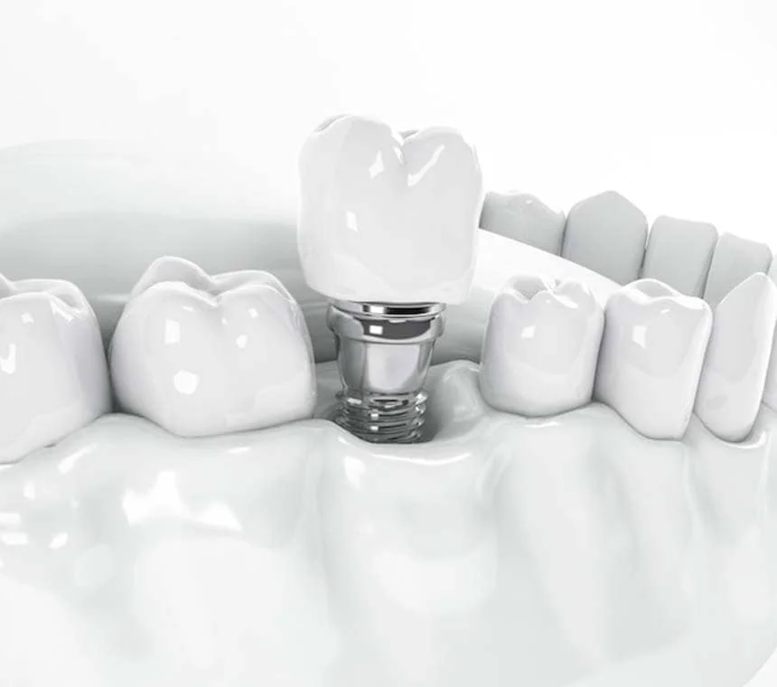 حرفه دندانسازی : انواع پروتز دندانی